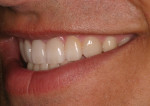 Postoperative natural smile left lateral view.