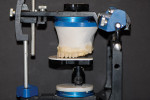 Figure 11  The platform of the dentofacial analyzer was lowered 2 mm, and the maxillary teeth were then waxed to form to the new platform height.