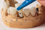 Final crowns and abutments seated on master cast.