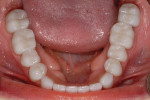 Figure 15  Occlusal view of mandibular arch with definitive restorations with modified onlays/veneers on all teeth.