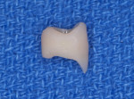 Figure 4  A custom-fabricated temporary crown was placed to ensure adequate contours and contacts.