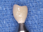 Figure 6  Temporary crown upon removal from the fixture (Figure 5) and after appropriately being contoured (Figure 6) in order to reflect a slight facial concavity at the facial gingival margin and a slight convex contour interproximally for support