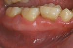 Figure 4  Retained primary dentition, as seen here, is common among those with T21.