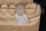 Figure 15 The tape adapts to the internal surface of the crown and will act as a 50-micron spacer for the cement.
