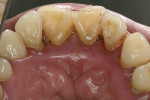 Figure 5  This patient with T21, who initially presented with spontaneous bleeding, shows inflamed palatal tissue.