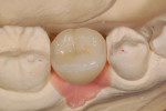 Figure 7 Restoration with ceramic insert in place on laboratory model. Note how well it blends in with the entire occlusal surface.