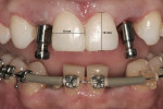 Figure 10 Prior to taking the final impression for the implant retained restorations, direct composite restorations were placed on the centrals and canines to achieve an ideal height-to-width ratio.