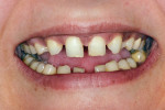 Figure 2 Close-up photograph revealed the aberrant sizes and shapes of the existing permanent anterior teeth.