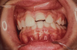 Figure 3. Injury sustained while wearing a boil-and-bite mouthguard.