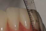 Measurement of the incisal length.