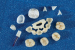 An array of zirconia milled abutments and restorations.