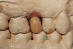 A full-contour wax-up of the hybrid abutment crown restoration that detailed the occlusal access hole was created.