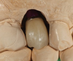 The pressed hybrid abutment crown was cut back for layering.