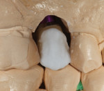 The facial incisal edge was layered with veneering ceramic.