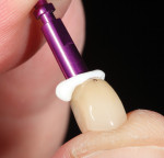 The lithium-disilicate crown restoration was seated onto the abutment and cleaned.