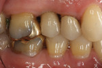 Lateral view of the final hybrid abutment crown restoration immediately after cementation.