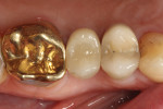 Occlusal view of the hybrid abutment restoration after sealing of the access hole.