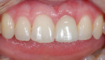 Implant restoration on tooth No. 9 after seating. Photography courtesy Dr. J. Camp