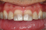 This patient presented for treatment wanting to change the appearance of his front teeth, which were severely discolored. The treatment plan comprised 10 veneers on the maxilla and 6 mandibular anterior veneers. The preparations were adapted to mask the horizon- tal banding. Clinical dentistry and photography courtesy Dr. J. Files.