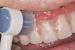 Figure 3 The Waterpik Ultra Water Flosser Toothbrush Tip may be used to remove bulk debris from the prosthesis.