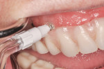 Figure 5 The Orthodontic Tip removes can maintain the exposed abutment collar.