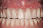 Figure 1 Initial clinical presentation of a maxillary acrylic “hybrid” prosthesis with evidence of poor hygiene.