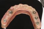 Figure 2 The intaglio surface of the prosthesis reveals significant plaque accumulation.