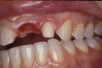 Figure 19 A long-term
provisionalization can create ovoid pontic form and create gingival health if adapted well.