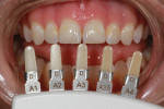 Figure 2 The IPS Empress Direct Dentin shade guide was used to select the ideal shade of dentin composite for the stratification technique.
