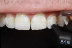 Figure 10 The enamel composite in shade A1 was applied.