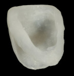 Figure 7  An acrylic “egg shell” using the Nealon technique was made and relieved on the palatal aspect maintaining the proximal contact areas and incisal position to allow complete seating over a screw-retained implant abutment.