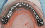 Figure 2  Milled hybrid titanium framework with molar full crowns.
