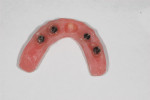 Figure 7 The pre-existing denture was modified, connecting the four temporary
abutments into the acrylic base with cold-curing pink acrylic. The center of the prosthesis was relieved to avoid contact with the healing abutment and premature, off-axis loading.