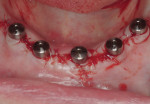 Figure 6 The five implants received 4-mm-height healing abutments, which were loosely tightened, except for the central implant, which would not support the immediately loaded temporary restoration.