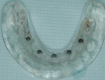 Figure 1 Clear acrylic duplicate of mandibular denture, containing five metal hollow tubes.
