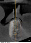 Figure 2 Cross-sectional view of proposed implant site in the position of tooth No. 23. The metal sleeve is visualized, and the drilling direction and long axis of the planned 4-mm x 13-mm implant can be appreciated.