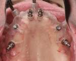 Figure 6 Surgical guide secured in place with guided stabilization pins. Implants placed fully guided to planned depth and angulation with implant mounts.