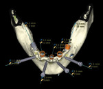 Figure 12 Full-arch treatment plan: two 30-degree posterior implants, three vertical anterior implants.