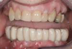 Figure 19 Insertion of immediate provisional restoration, mandible.