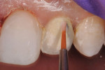 Figure 9 A pink opaquer was painted over the metal substructure of the implant restoration.