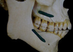 Figure 1  Normal attachments of buccinator muscle on the maxilla and mandible.