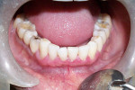 Figure 6  Reduced gingival inflammation 2 weeks after corticosteroid and retinoid therapy.