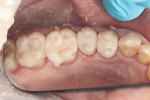 Figure 5 Try-in of milled restorations.