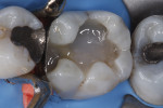 Figure 3 Tooth No. 30 after isolation, application of adhesive, and application of initial layer of Surefil SDR flow.