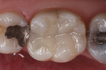 Figure 4 The final mesio-occlusal restoration of tooth No. 30.