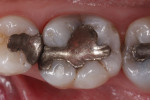 Figure 1 Preoperative appearance of tooth No. 30.