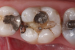 Figure 2 Preparation of tooth No. 30 after the amalgam restoration was removed.