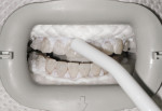 Figure 11 Surgical suction is used to remove bleaching agent to avoid dislodging barrier.