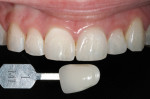 Figure 14 Three-week posttreatment results without supplemental whitening show no perceptable relapse.