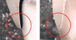 Figure 1 A typical porcelain-fused-to-metal (PFM) preparation with a conservative feather-edge margin (left) compared with the typical PFM preparation with a BruxZir crown in place (right). The bulky 1-mm margin on the PFM catches on the explorer. Even if the margin is sealed, the emergence profile is unacceptable. The monolithic crown can be milled to a feather edge without bulk of material at the margin.